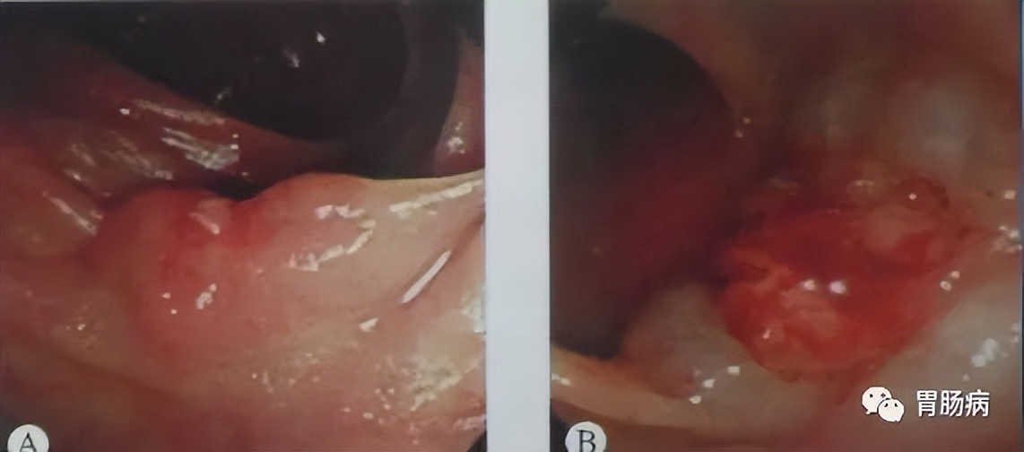 esd内镜下粘膜剥离几天可愈合,内镜下粘膜剥离术属于esd还是emr