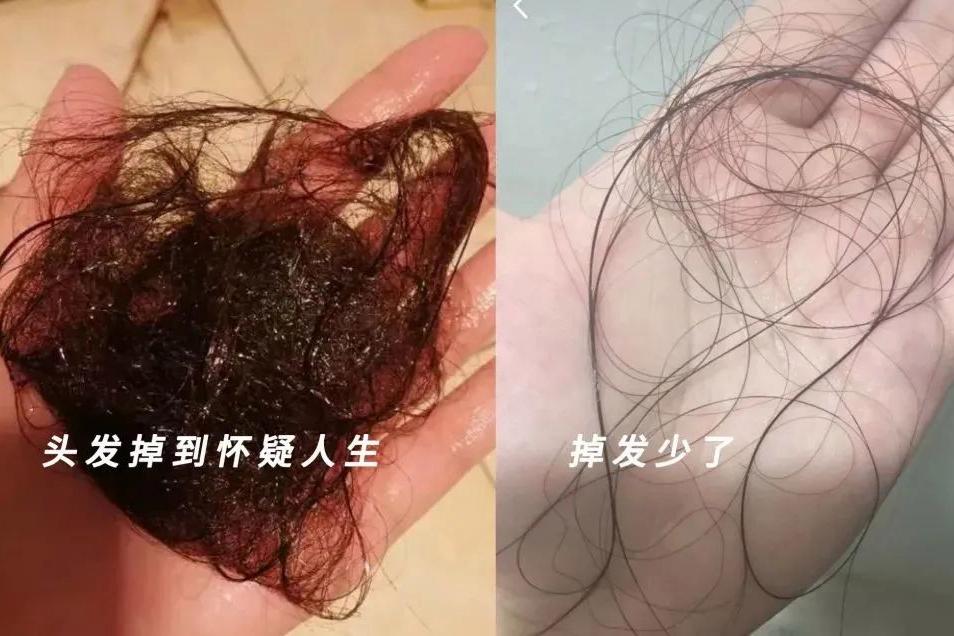 头顶头发稀疏露头皮治疗,头顶稀疏露头皮怎么办