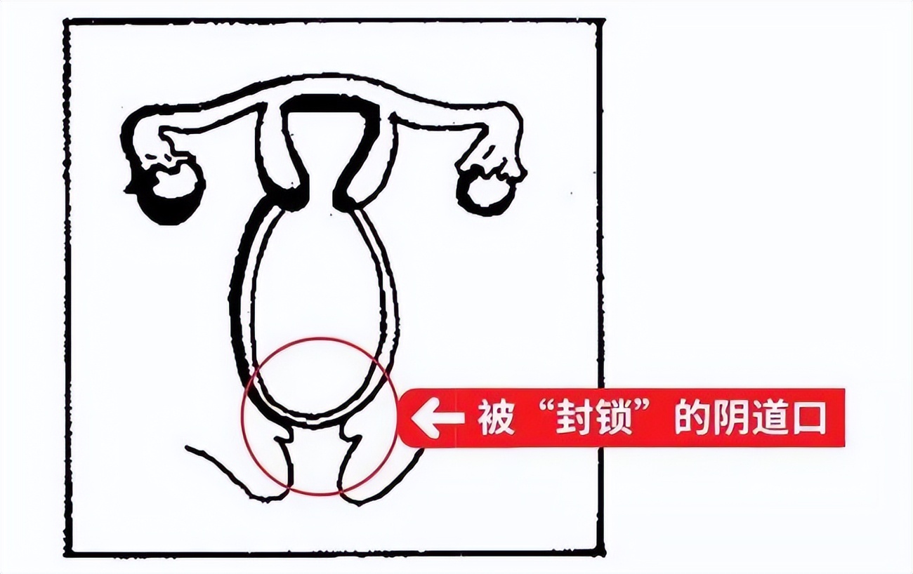 女性第一次发生*行为性**后，真的会“落红”吗？