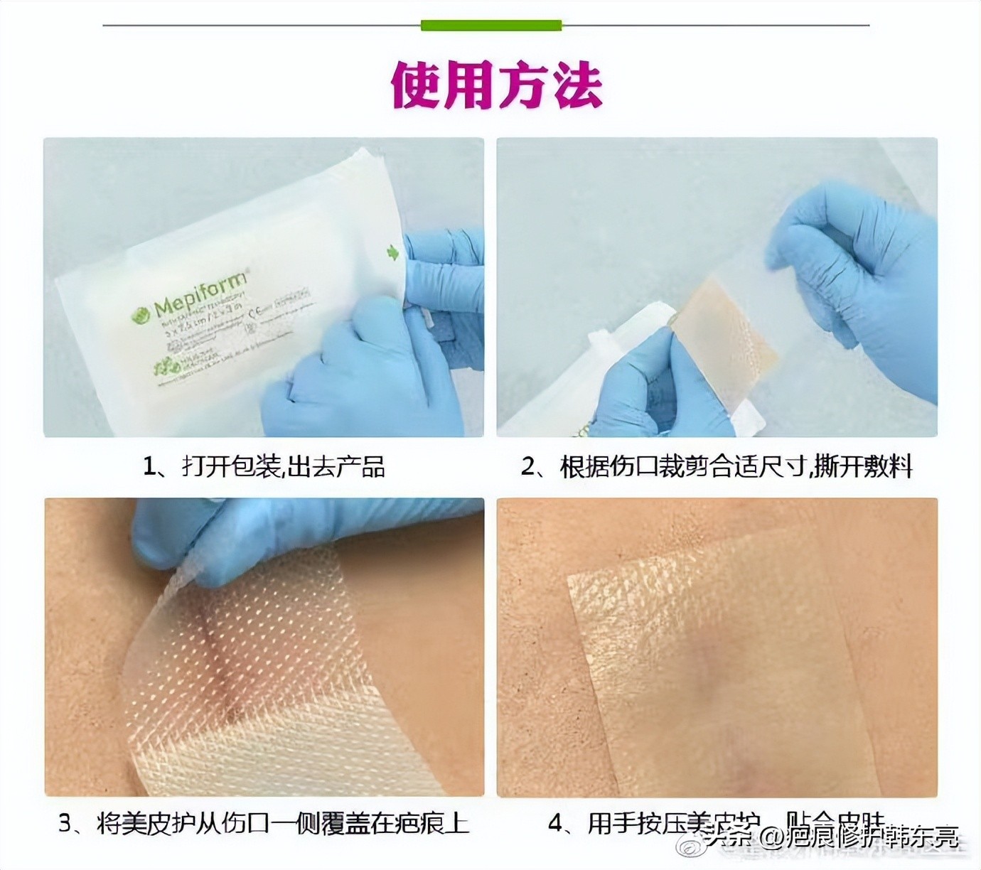 疤痕美肤怎么做,多久的疤痕适合用美皮护