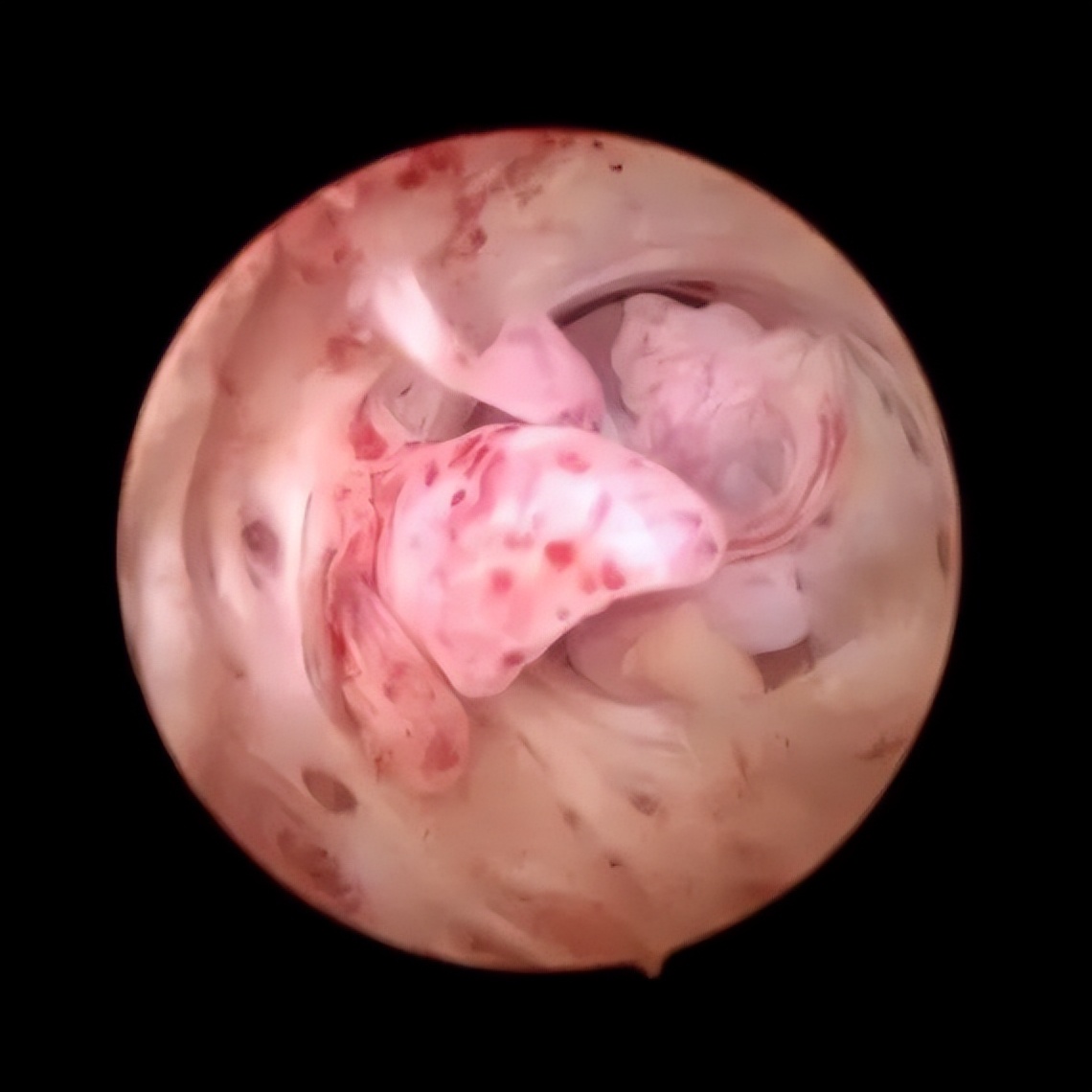 妇科宫腔镜科普宣教,关爱子宫神奇的宫腔镜