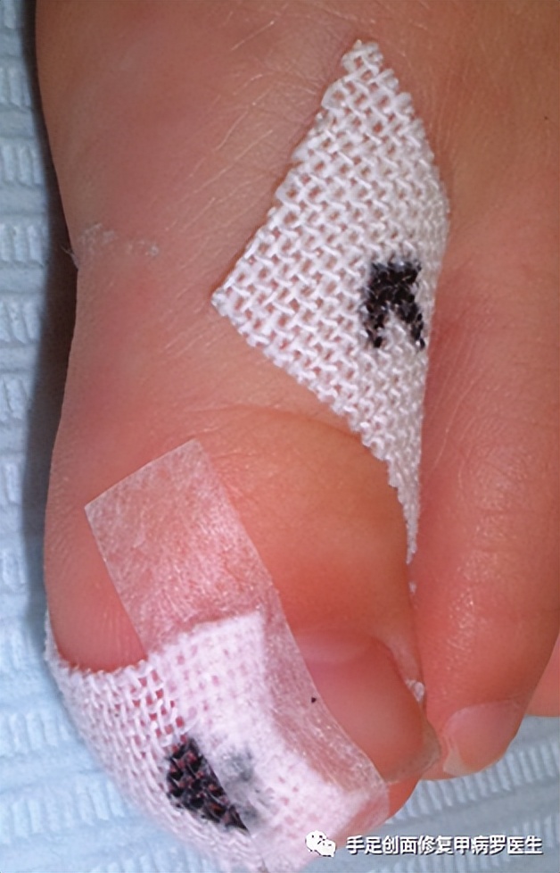 大脚趾甲流脓是怎么回事,婴儿指甲流脓怎么办