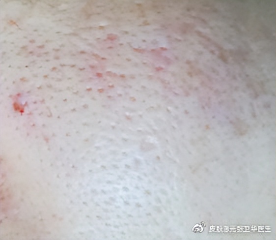 痘印痘坑要怎么去掉才能不留疤呢,为什么你脸上会长痘痘