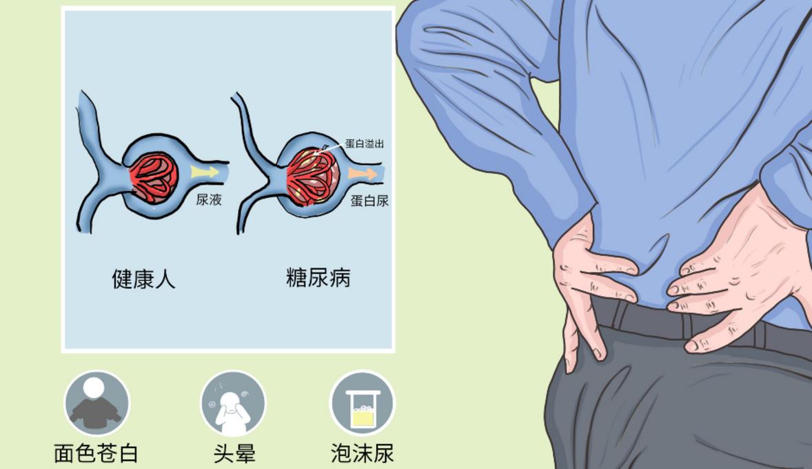 小便泡沫多和肾有什么关系,尿尿泡沫多是肾阴虚还是肾阳虚