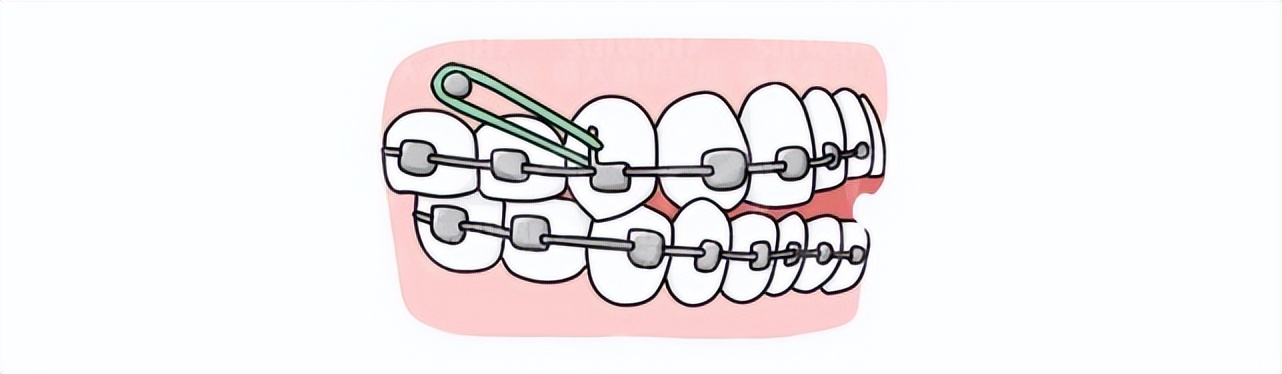 刚做完牙套怎么能快速恢复,戴牙套最难熬的阶段要怎么处理