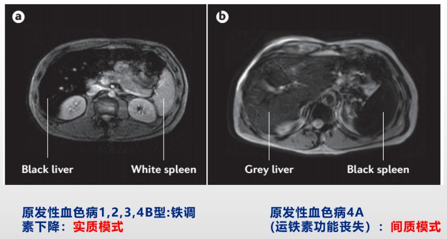 郑素军谈乙肝难点,肝病专家郑素军