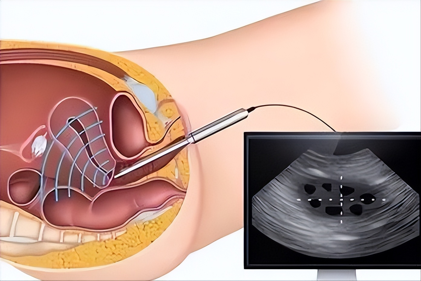 阴式b超都可以检查什么,阴式b超都能检查哪些方面