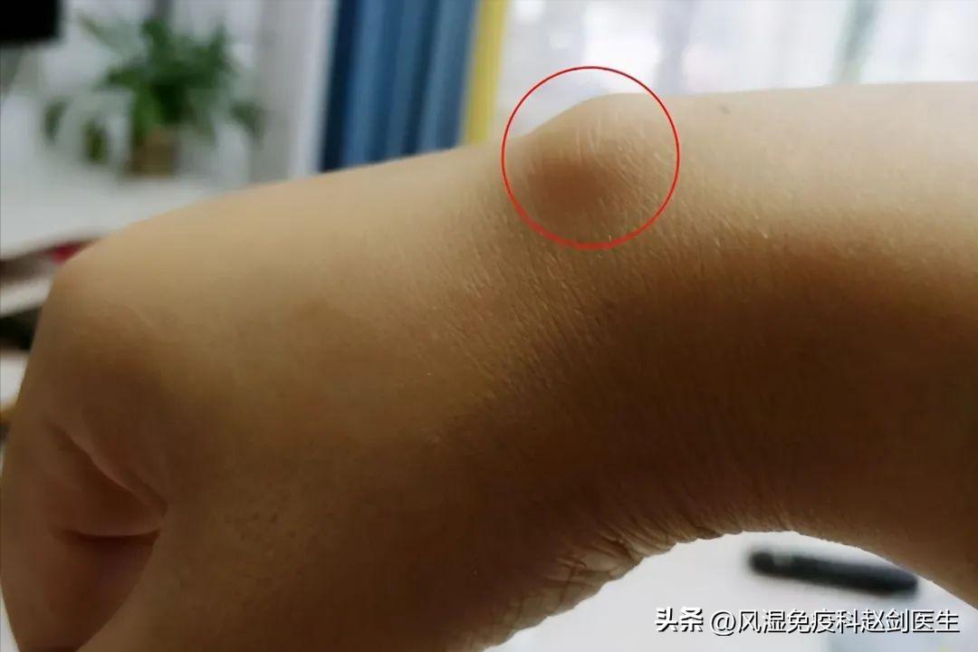 敲键盘手腕酸疼,敲键盘手腕肿痛