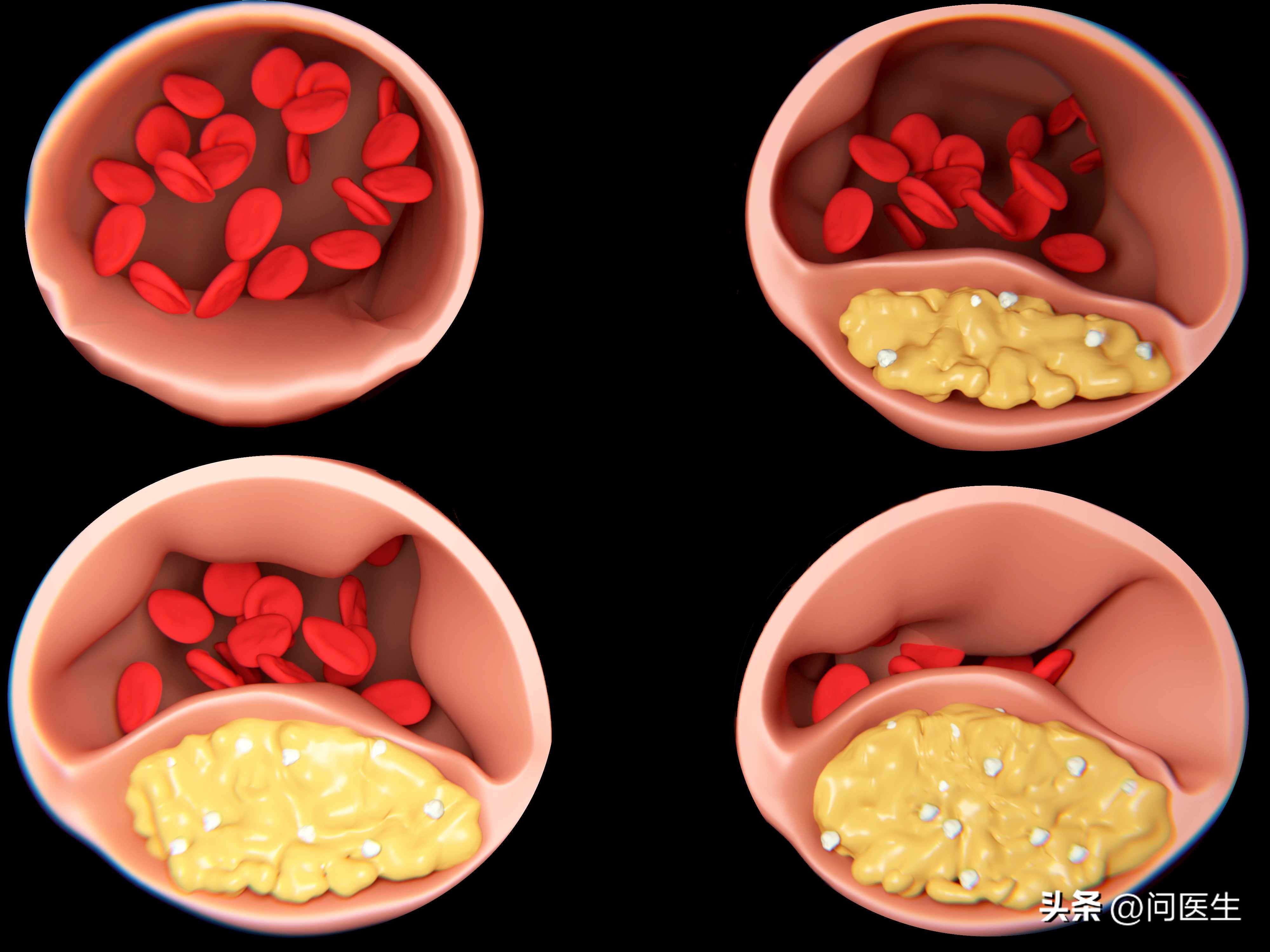 为什么年轻人也频频出现高血脂？中青年该如何调控自己的血脂呢？