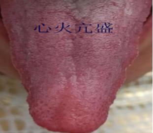 舌根部有裂纹是什么舌象,舌有裂纹7种原因通过舌象来调理
