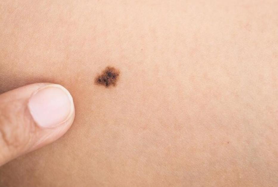 黑痣发生这些变化时要警惕,医生长在摩擦部位的黑痣要当心