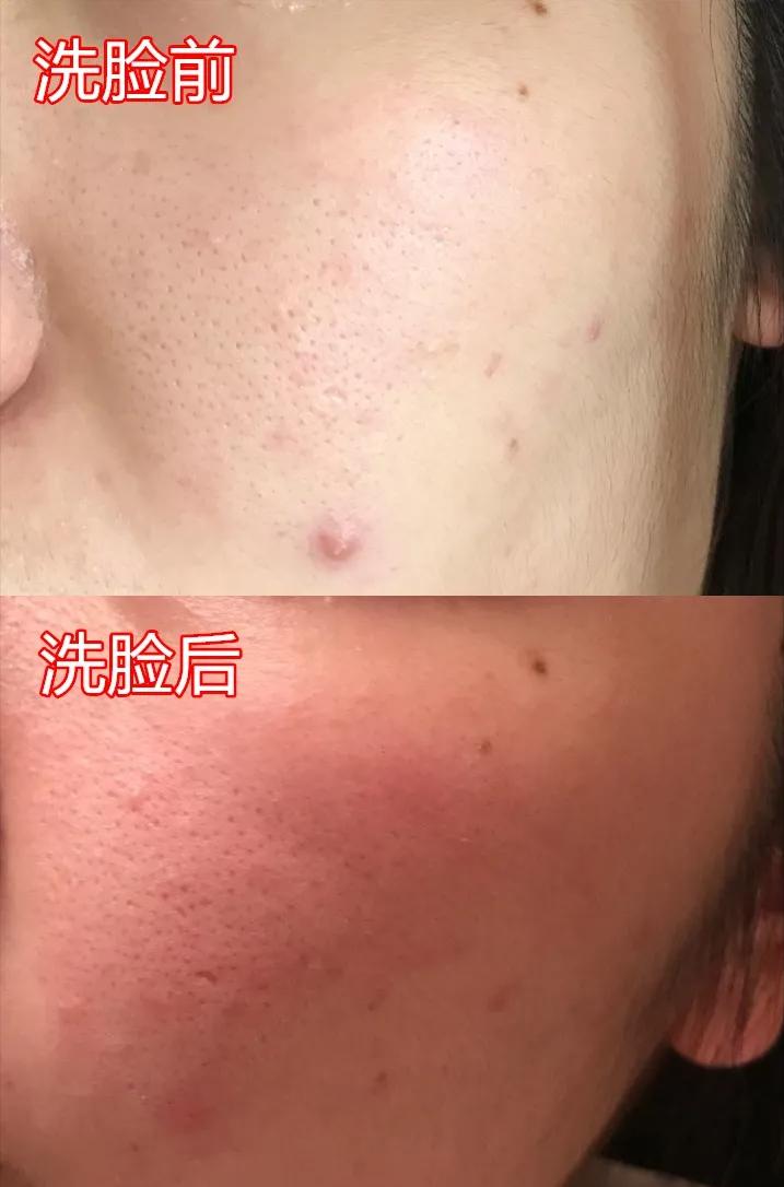 脸泛红是洗面奶的原因吗,为什么用完洗面奶脸会变白