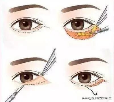 眶周治疗,眶周水肿的处理