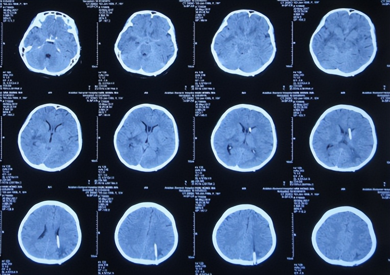 结核性脑积水能治愈吗,儿童结核脑膜炎脑积水