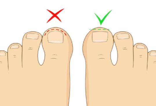 甲沟炎疼痛是指甲在长吗,甲沟炎红肿疼痛怎么快速消肿止疼