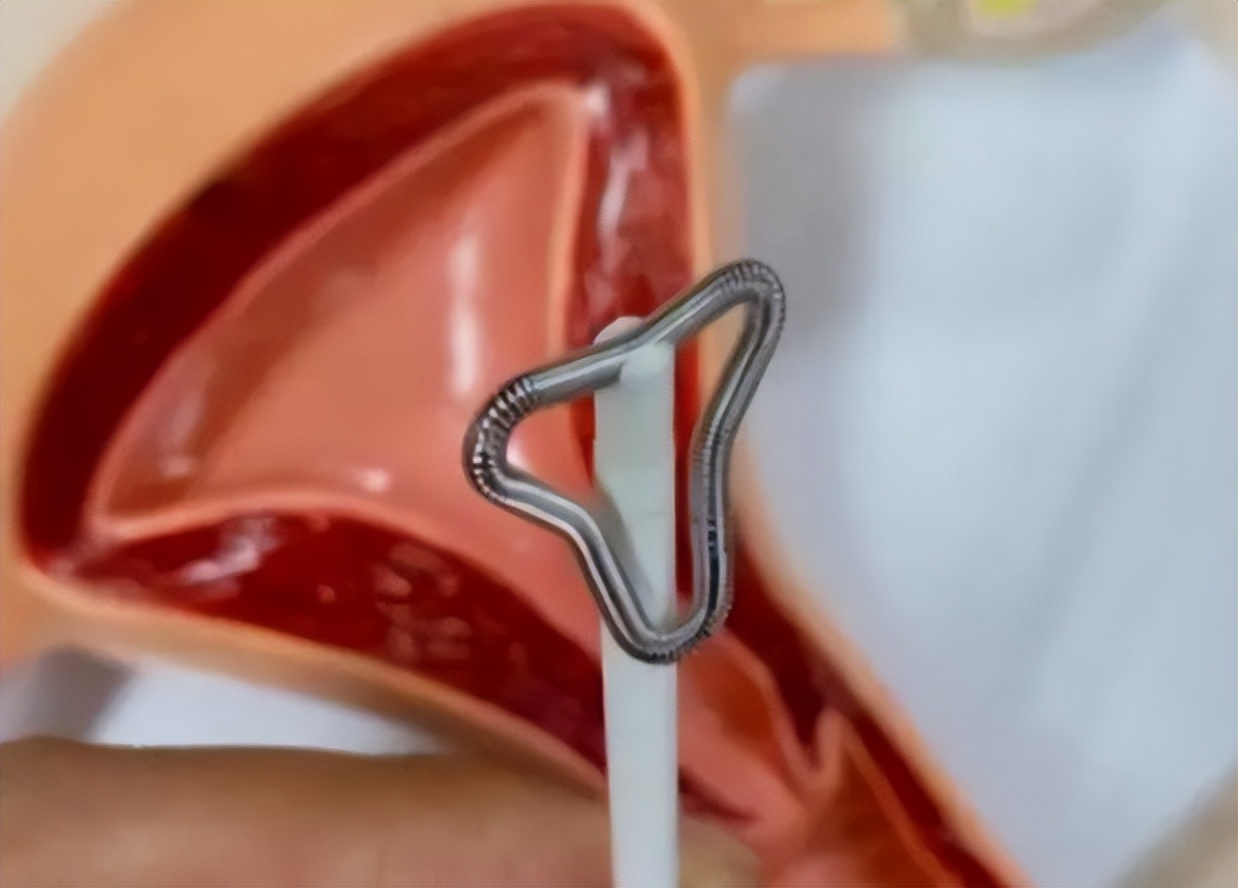 第一批女性上环的结局,中国女性上环