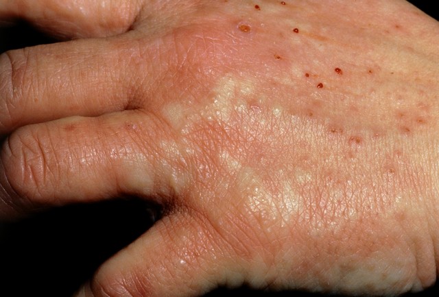 湿疹湿疮的区别,湿疹湿疮的中医治疗