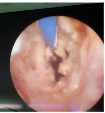 上尿路上皮癌根治性切除术,输尿管高级别浸润性尿路上皮癌