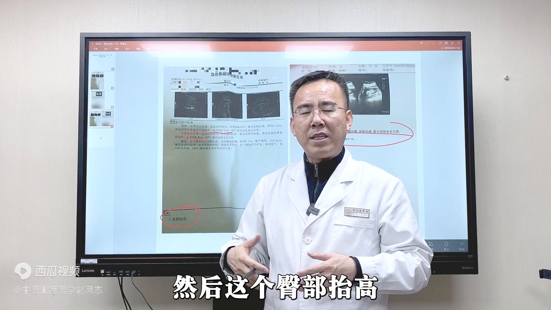 双肾结石，服药调理60天，结石消失不见！