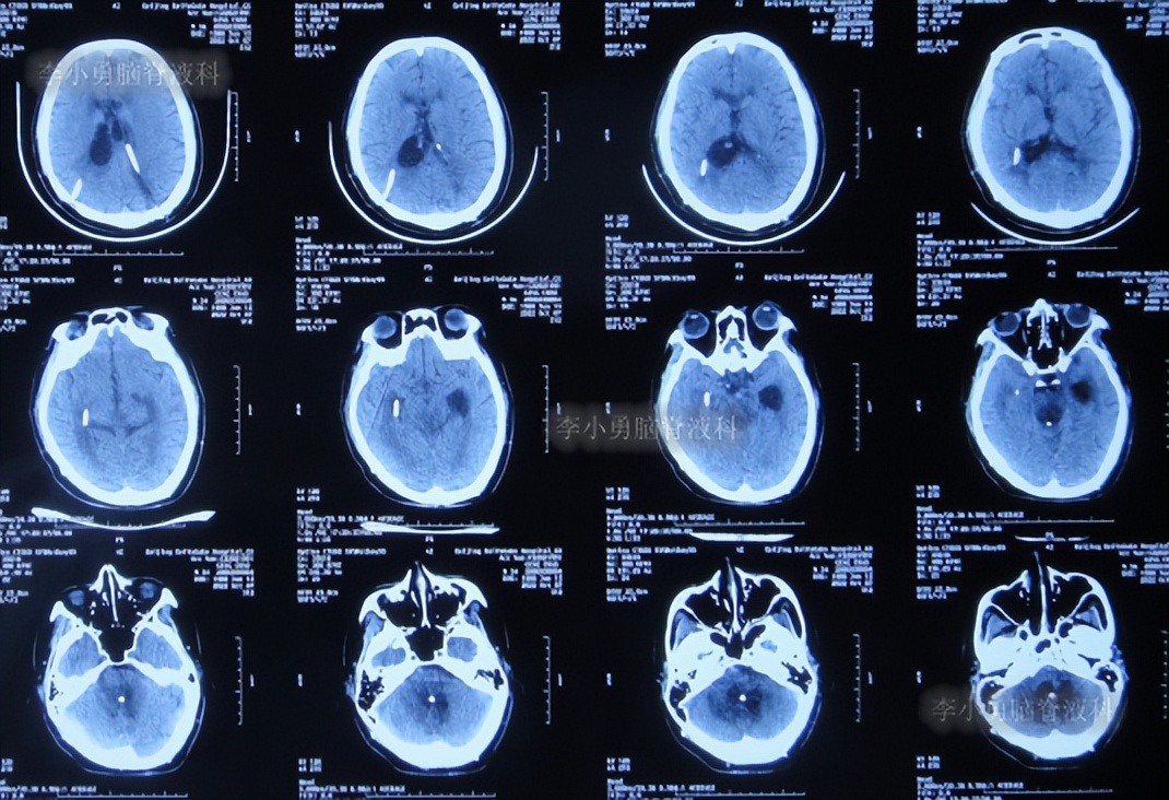 脑积水三脑室造瘘多久能恢复,脑囊虫手术后脑积水