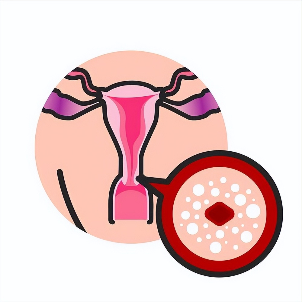 老年宫颈癌的早期信号用什么药,盆腔积液是宫颈癌的早期信号