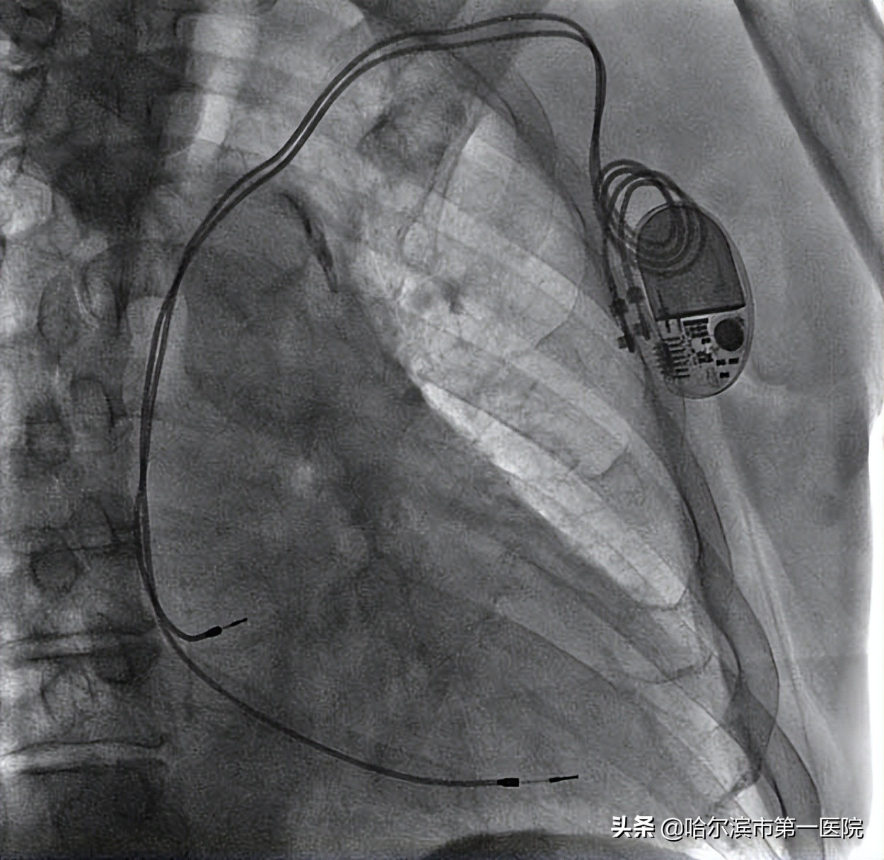 哈尔滨市第一医院心律失常起搏治疗开启新时代为高龄老人植入“抗核磁全自动超大电池容量”心脏双腔起搏器