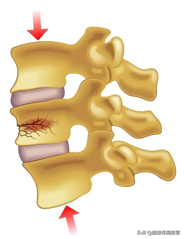平背的成因,平背怎么造成的