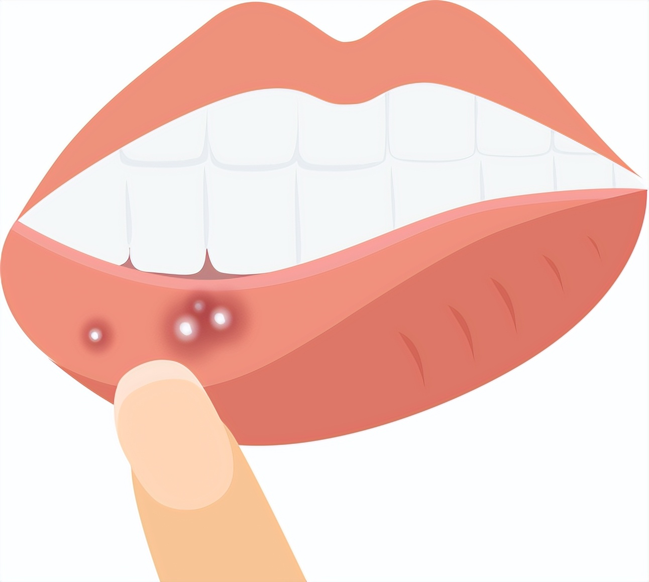 吃辣可以促进口腔溃疡愈合吗,吃辣的可以缓解口腔溃疡吗