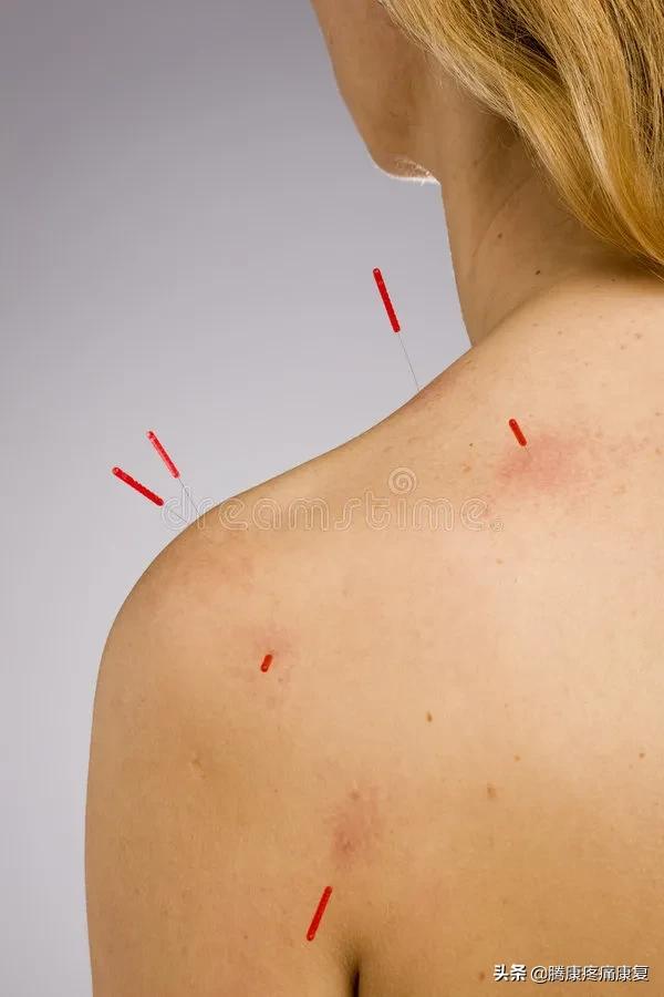 颈椎病引起肩胛骨疼痛怎么缓解,右肩胛骨下方疼痛如何运动缓解