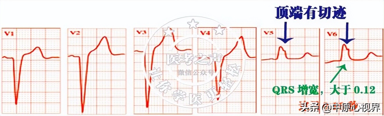 护考几种常见的心电图,常见的心电图图形分析