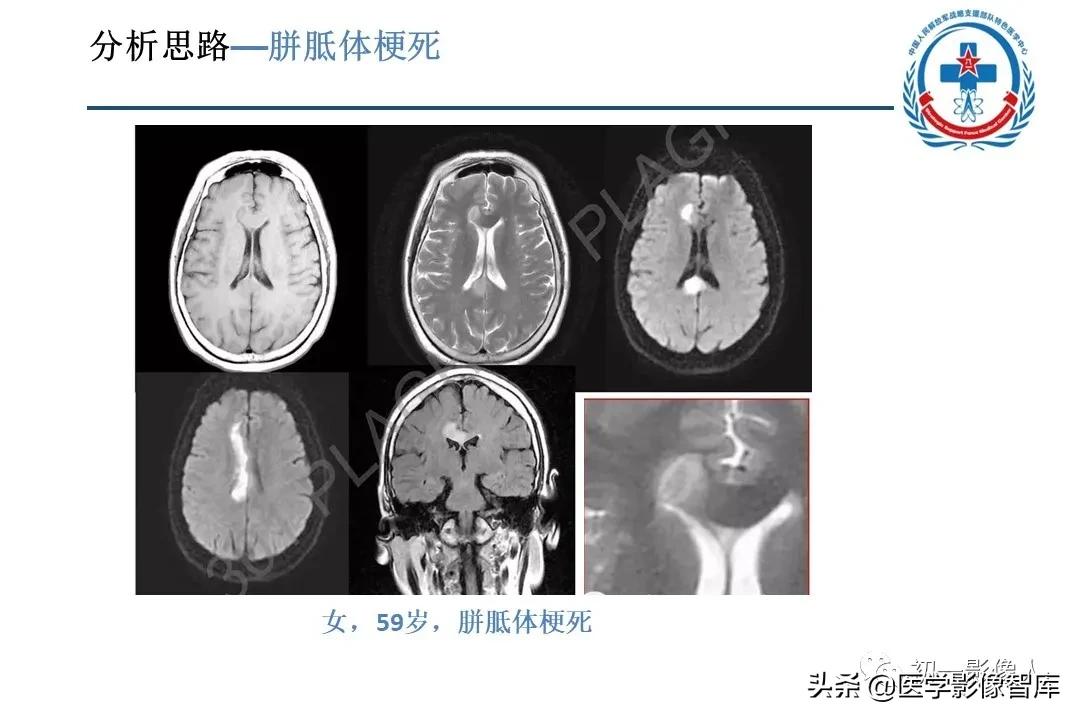 胼胝体变性治疗方法,原发性胼胝体病变治疗
