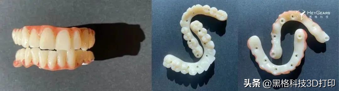 病例分享|美国BDG诊所实现全口即刻修复病例一则