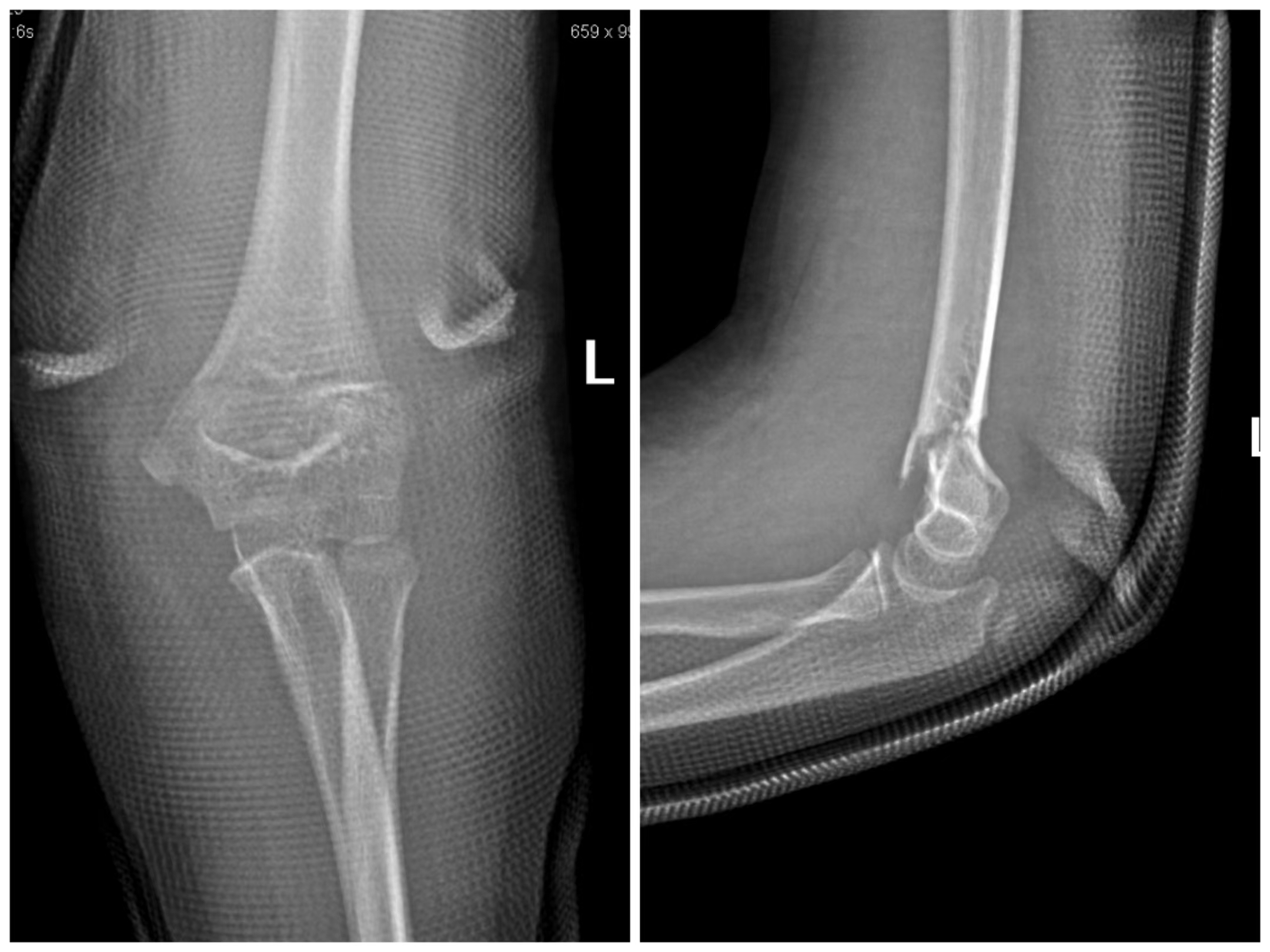 骨折了家长怎么办,儿童骨折家长怎么处理