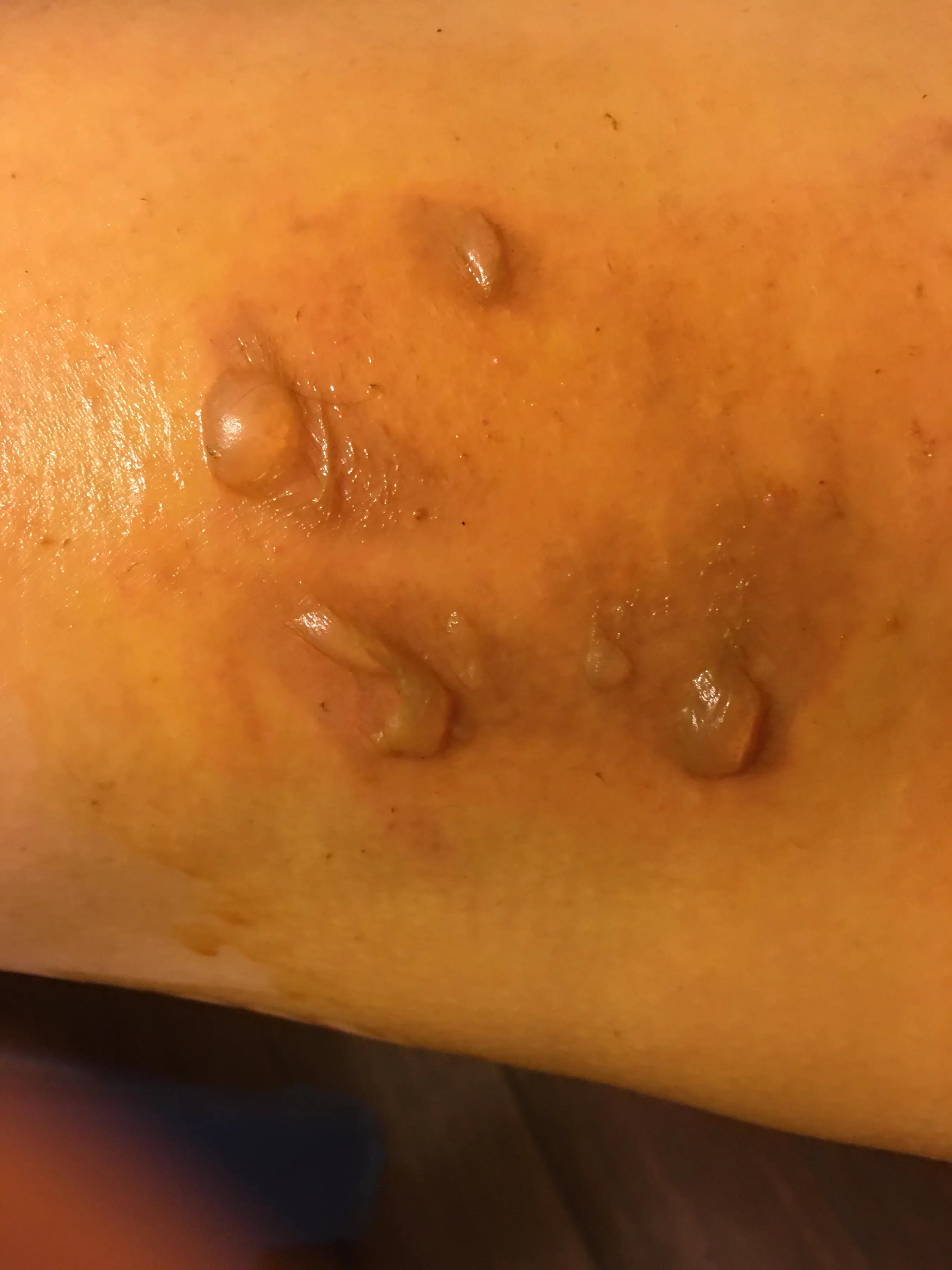 烫伤后续治疗费用怎么赔,烫伤的处理以及案例分析