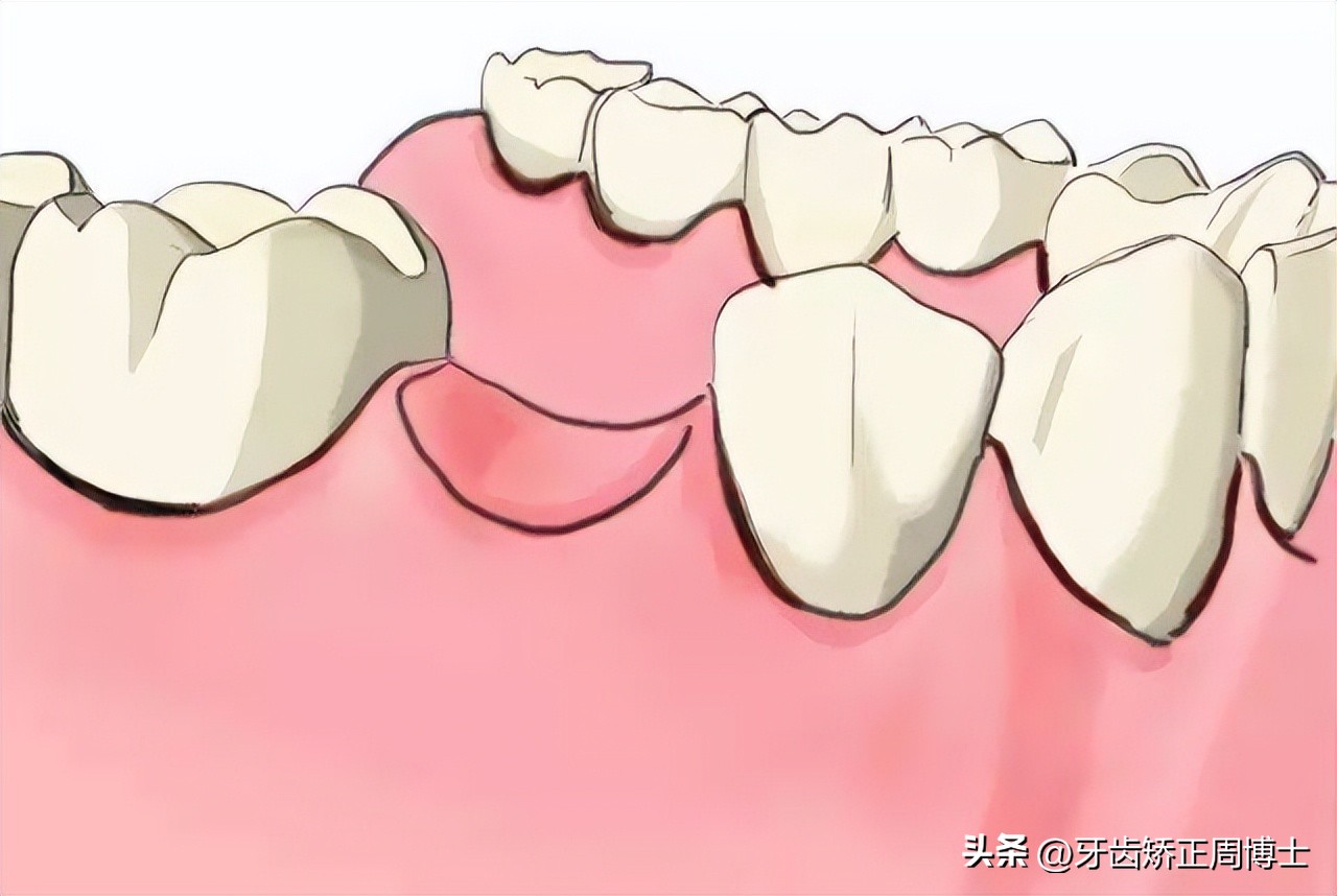 即刻种植即刻修复免受缺牙的痛苦,缺牙不补倾斜矫正价钱