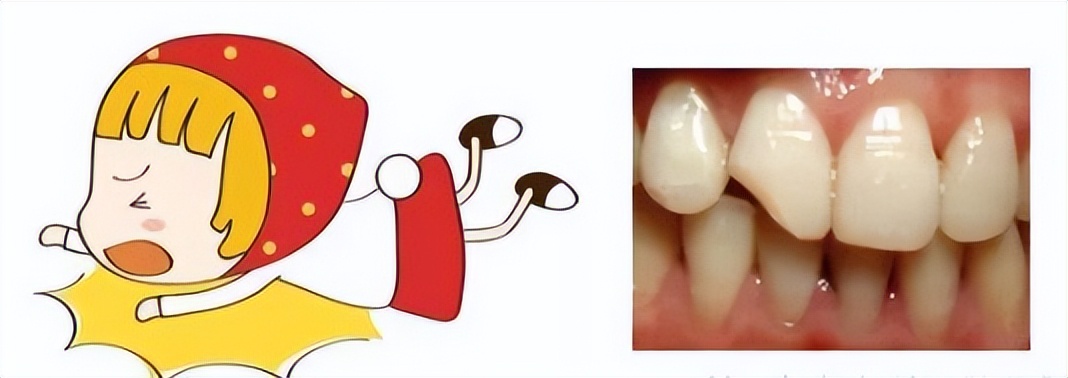 摔了一跤牙碰了半年还隐隐痛,摔了一跤牙齿磨掉了