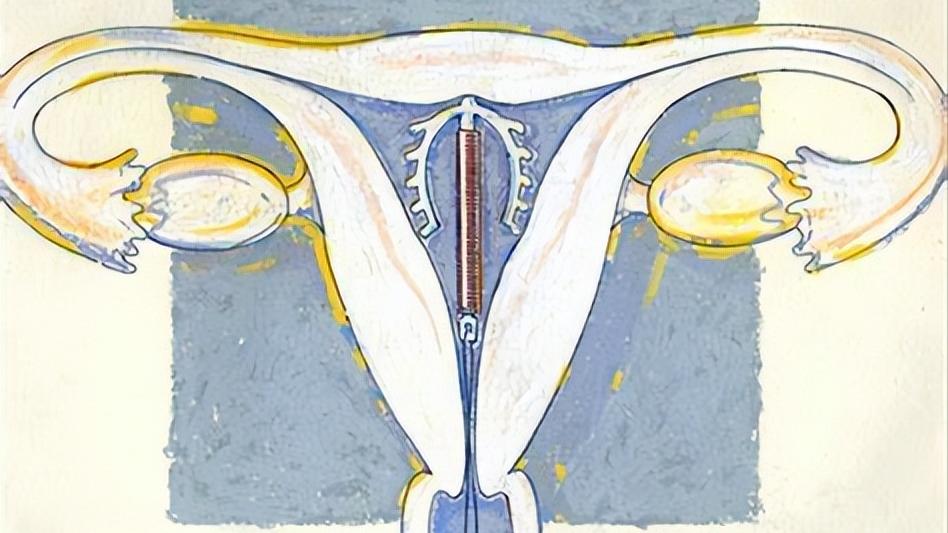 以前上环的女性30多年后现状如何,我国第一批上环的女性现在怎么样