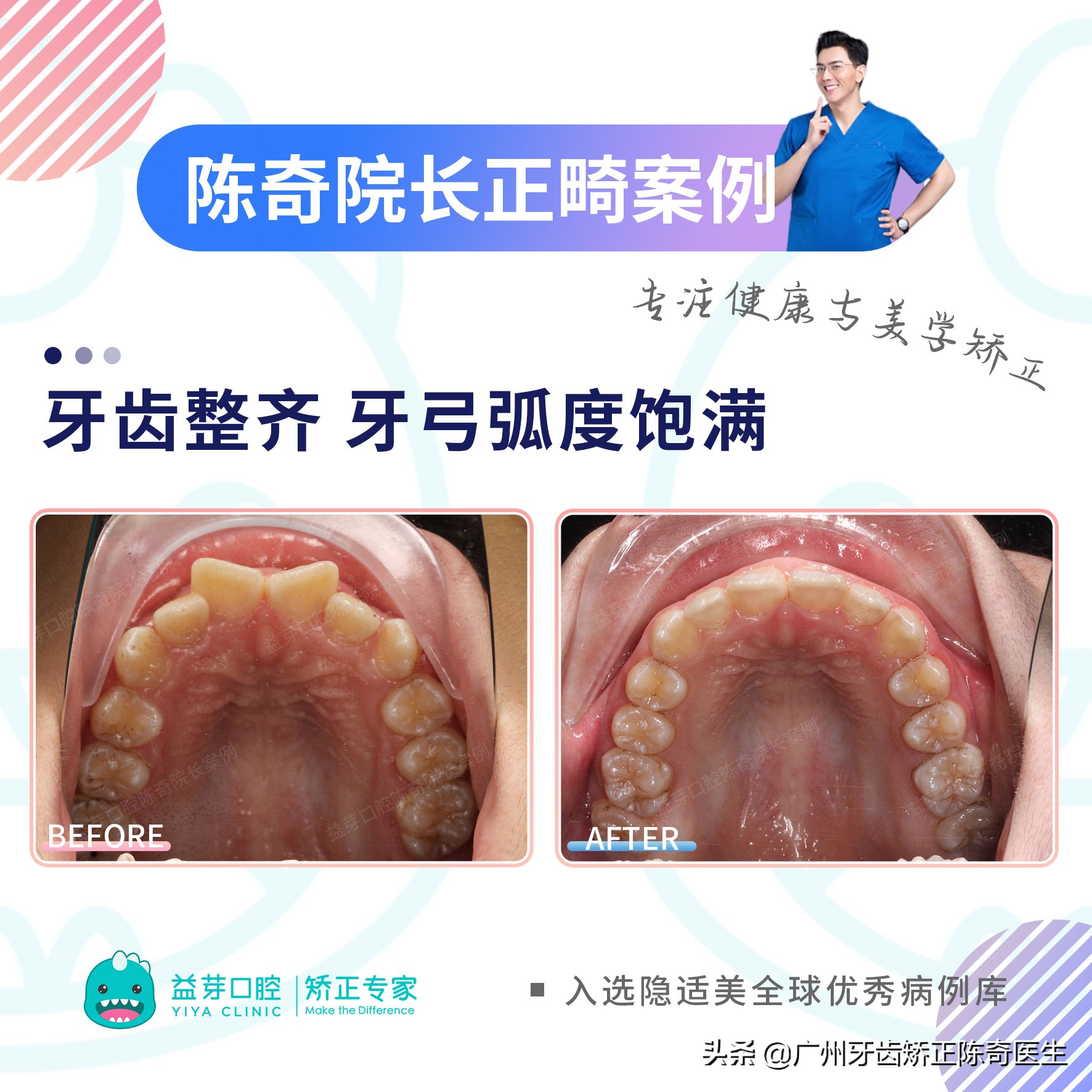 11岁女孩牙齿前突需要扩弓吗,16岁女生上颌骨前突矫正