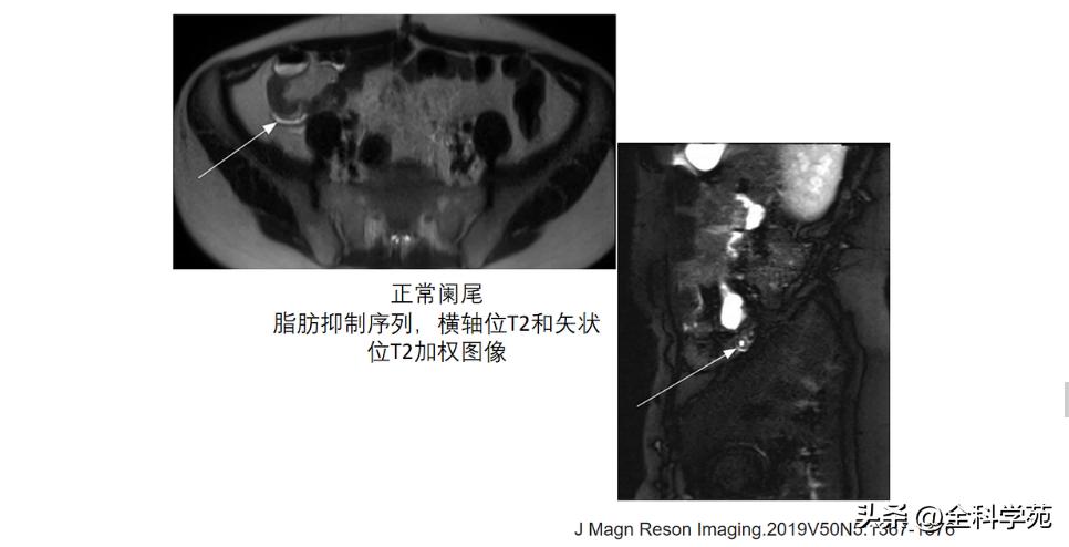 阑尾炎的讲解,关于阑尾炎的讨论总结