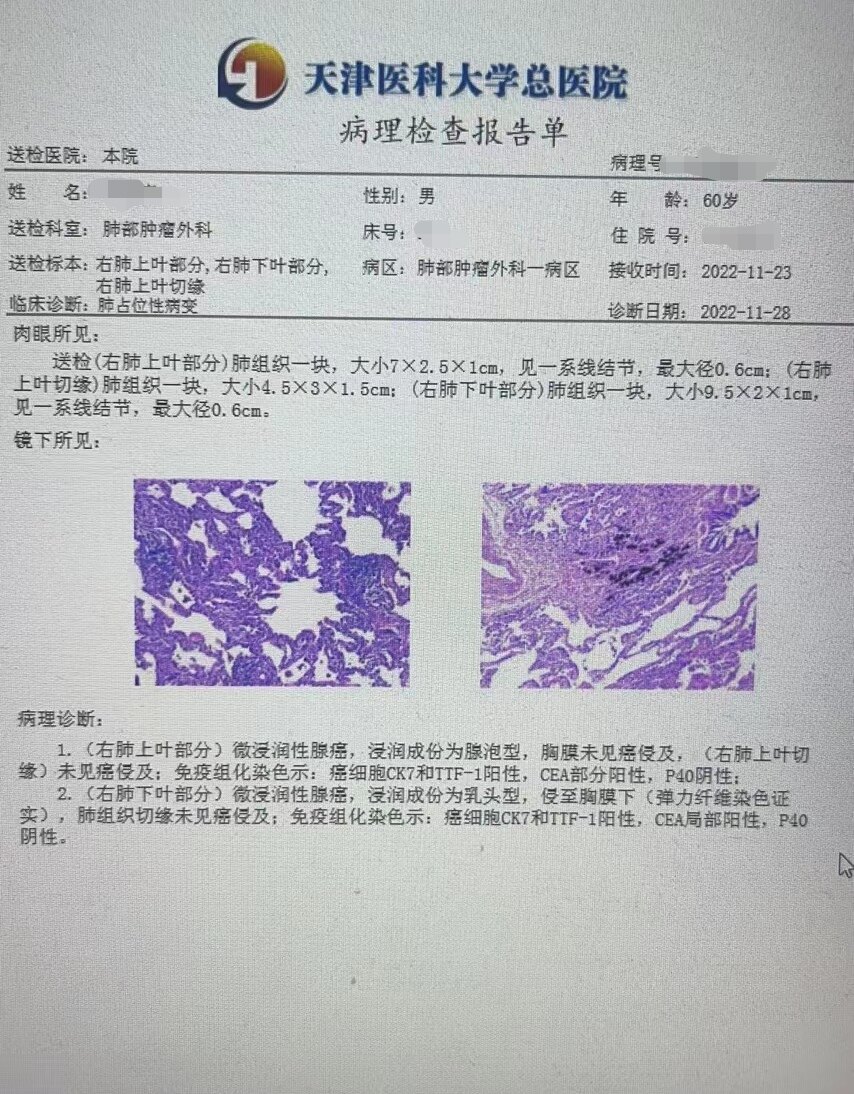 刘懿博士说肺癌化疗,刘懿博士说肺癌的书