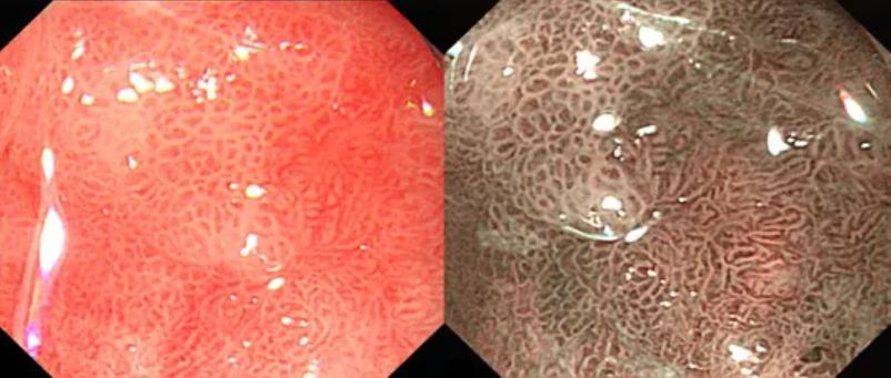 肺癌支气管镜盲检的概率,肺癌气管镜病理分析