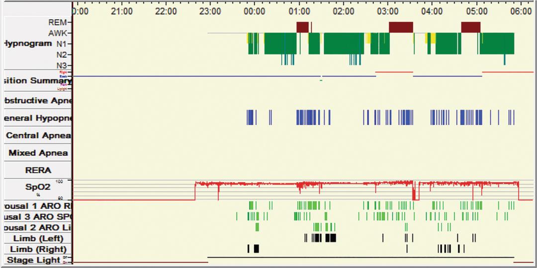 白天嗜睡昏昏欲睡什么症状,白天嗜睡是什么病的前兆