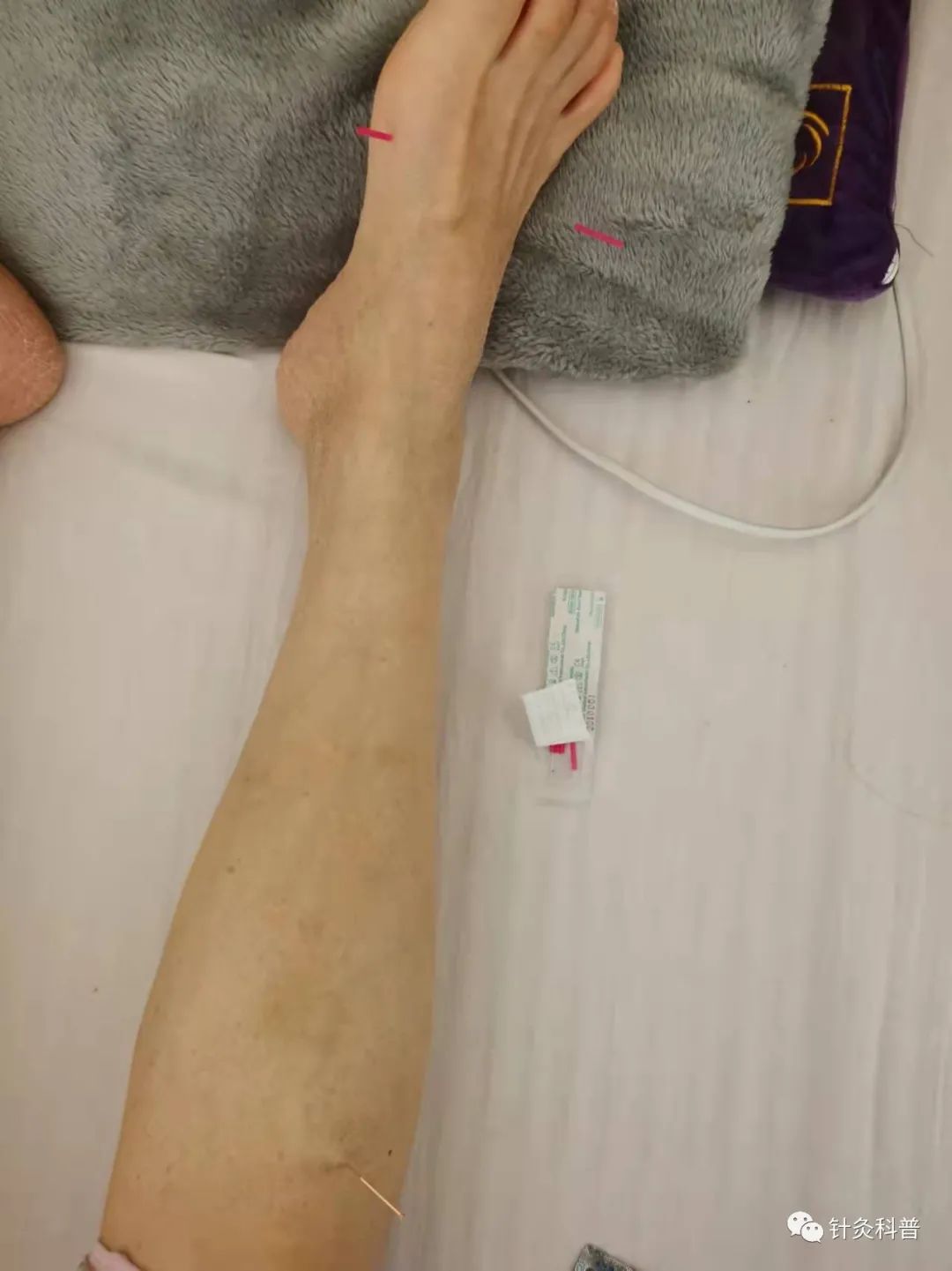 脉诊针灸穴位,董氏针灸治疗青光眼处方