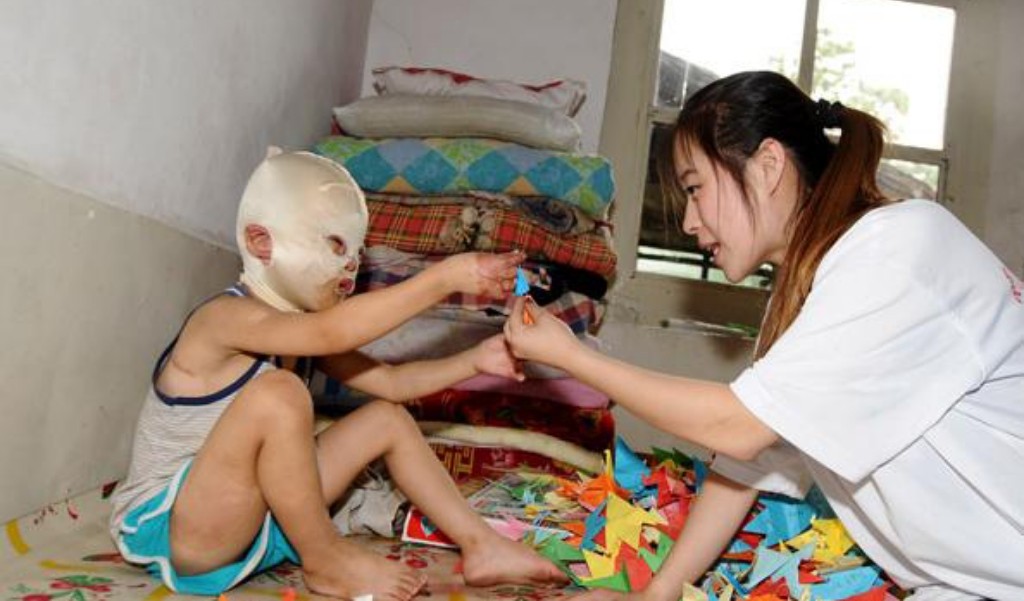 小孩子脸被火烧伤戴着面具,因烧伤带面具的山西小男孩