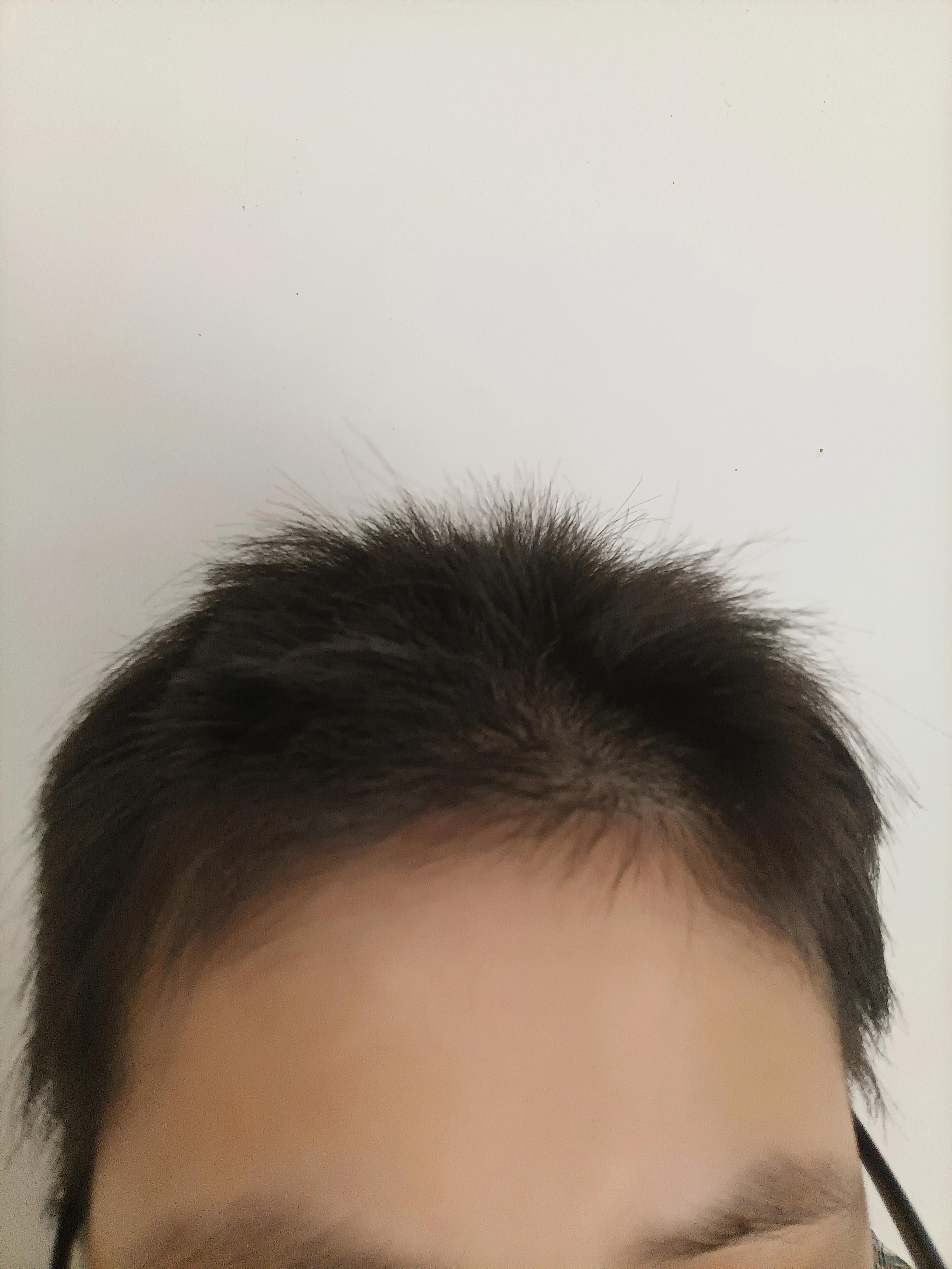 治疗脱发断发的方法,脱发和断发的区别图