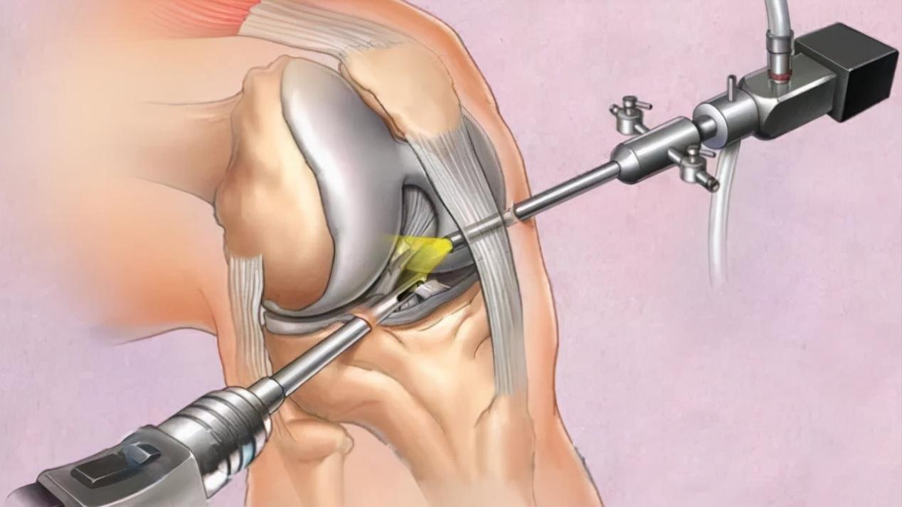 膝盖疼痛的自我康复训练方法,三个日常小习惯保护膝盖缓解膝痛