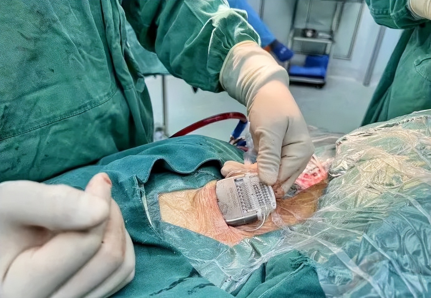 智能可感知脑起搏器植入手术,山西省首例机器人植入脑起搏器