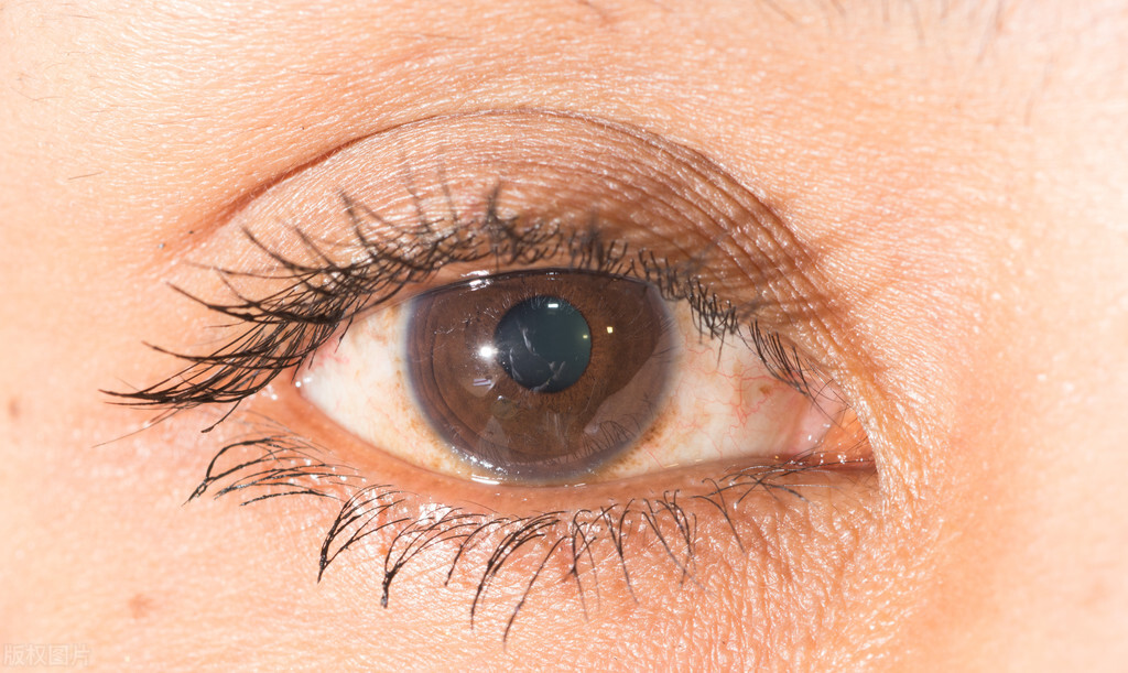 脸上的老年斑到底能不能彻底祛除,有哪些可以去除脸上的老年斑