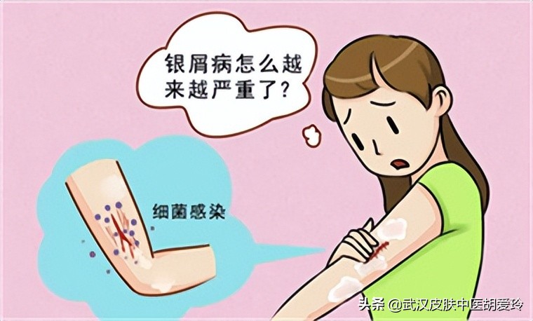 脾胃湿热引起的牛皮癣怎么治疗,湿热蕴积型牛皮癣症状