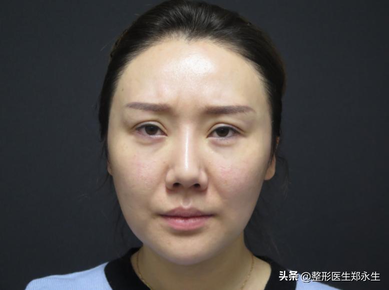 双眼皮修复恢复过程经历真实,修复双眼皮的亲身经历